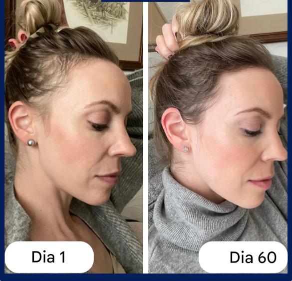 Sumlife Sistema de aplicação HairRevive™ Roll-on